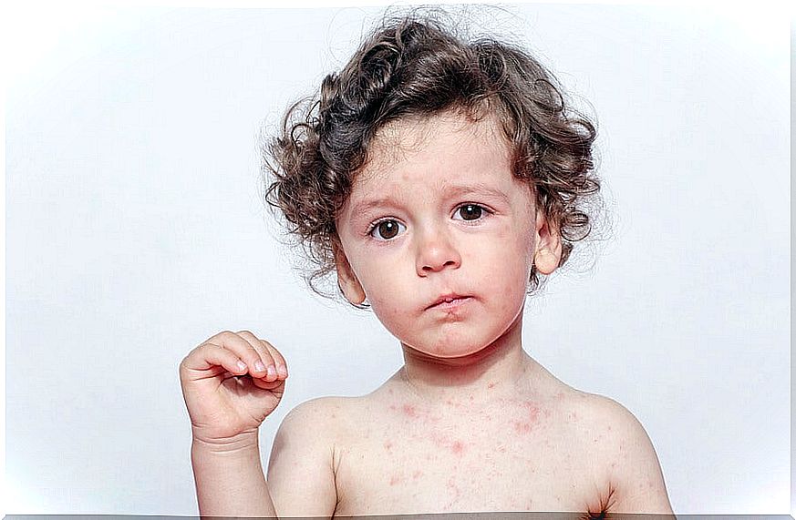 Sweat allergy in children is not usually a serious problem.