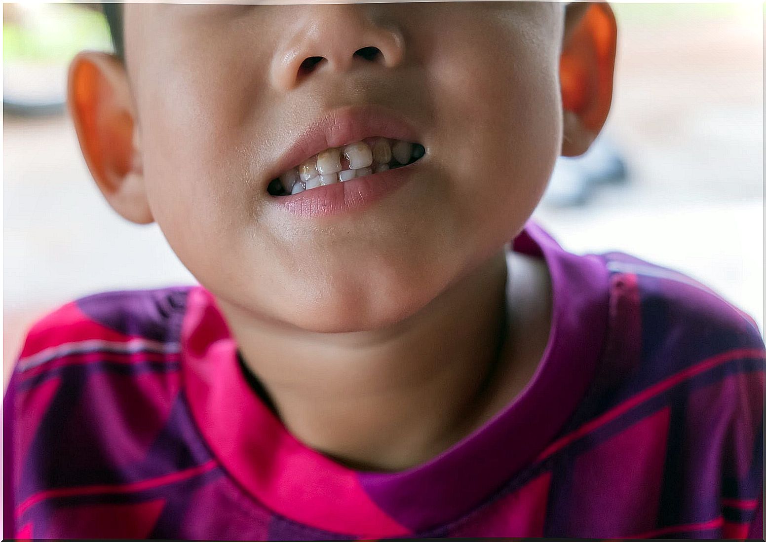 Child with early childhood tooth decay.