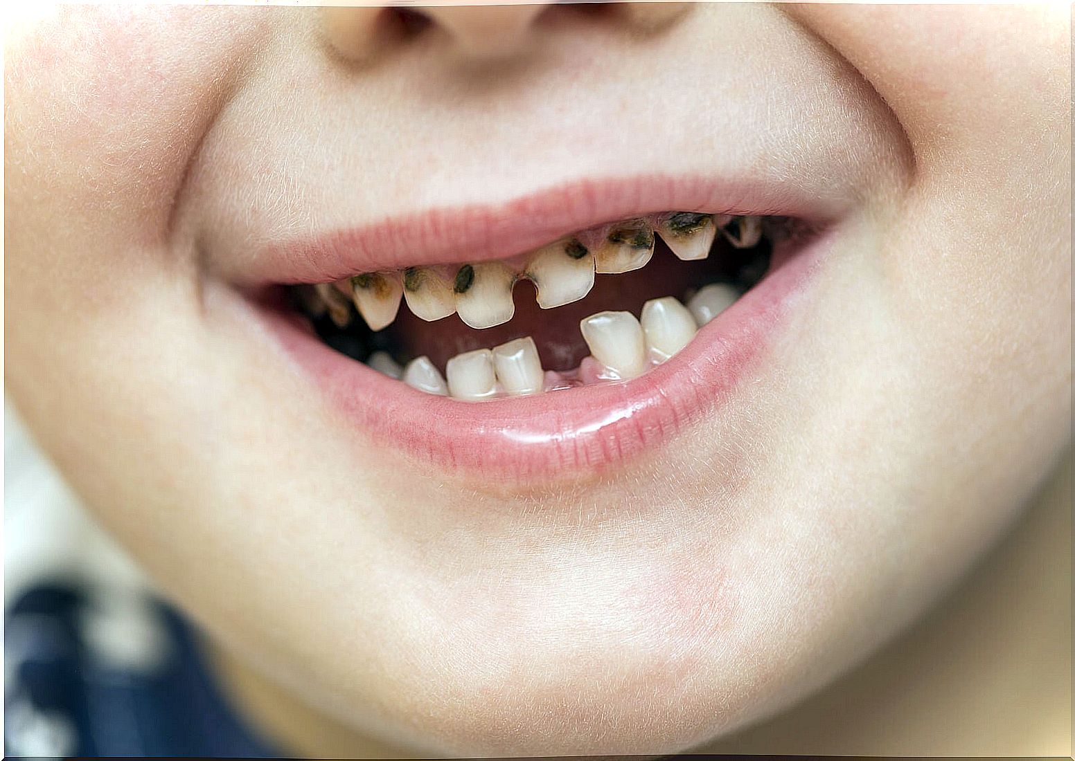 Child with a mouth full of early childhood tooth decay.