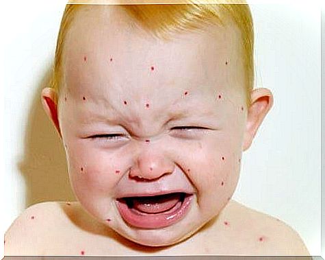 Know everything about chickenpox