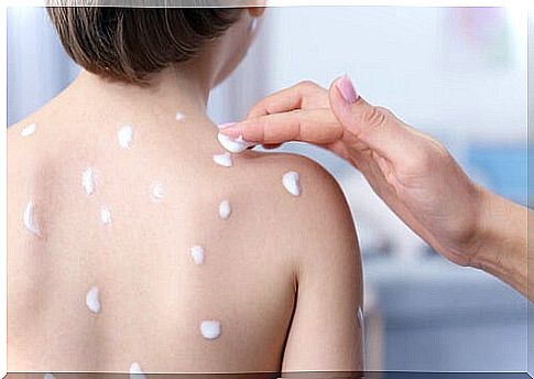 Chickenpox care.