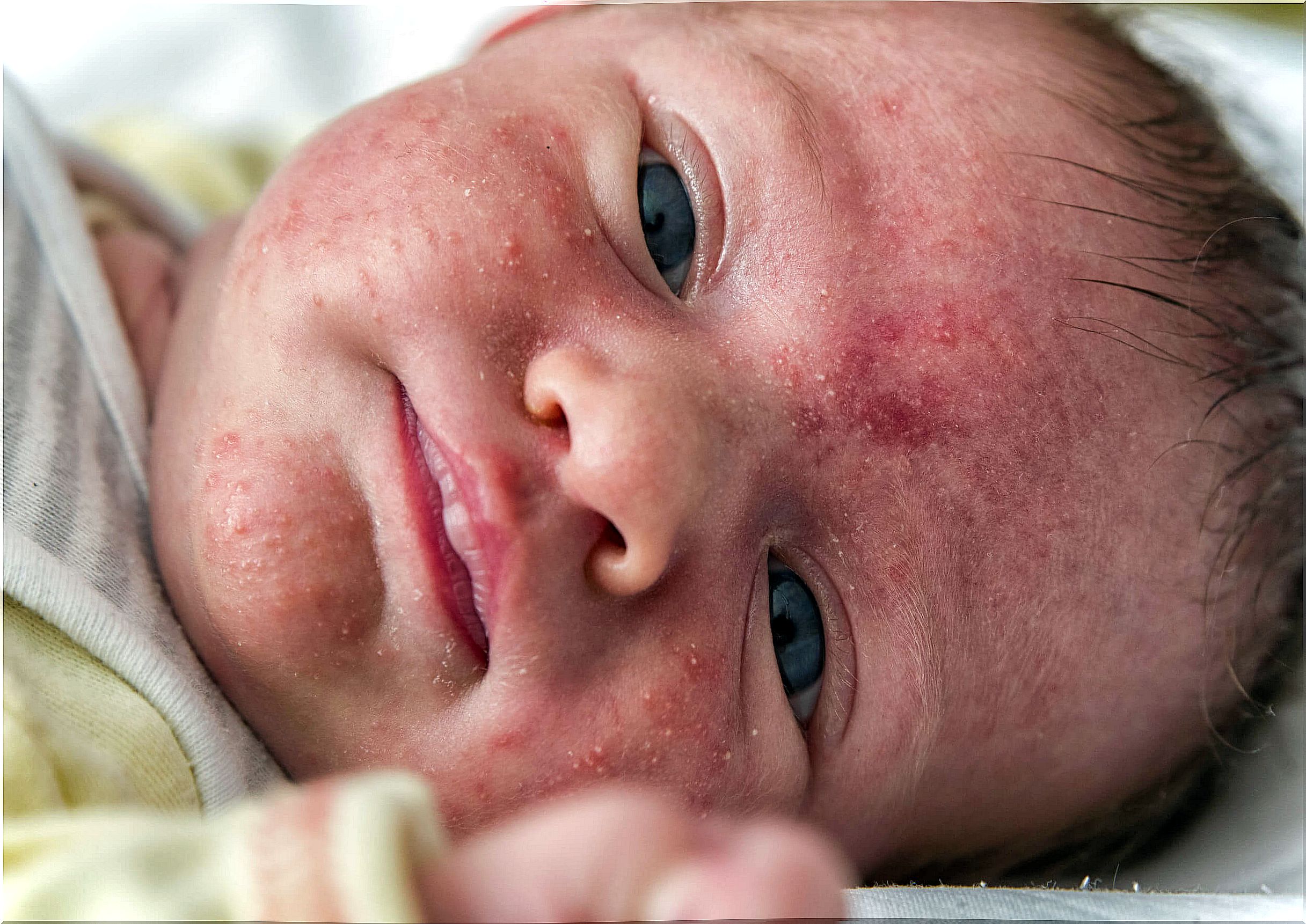 Baby with neonatal acne.