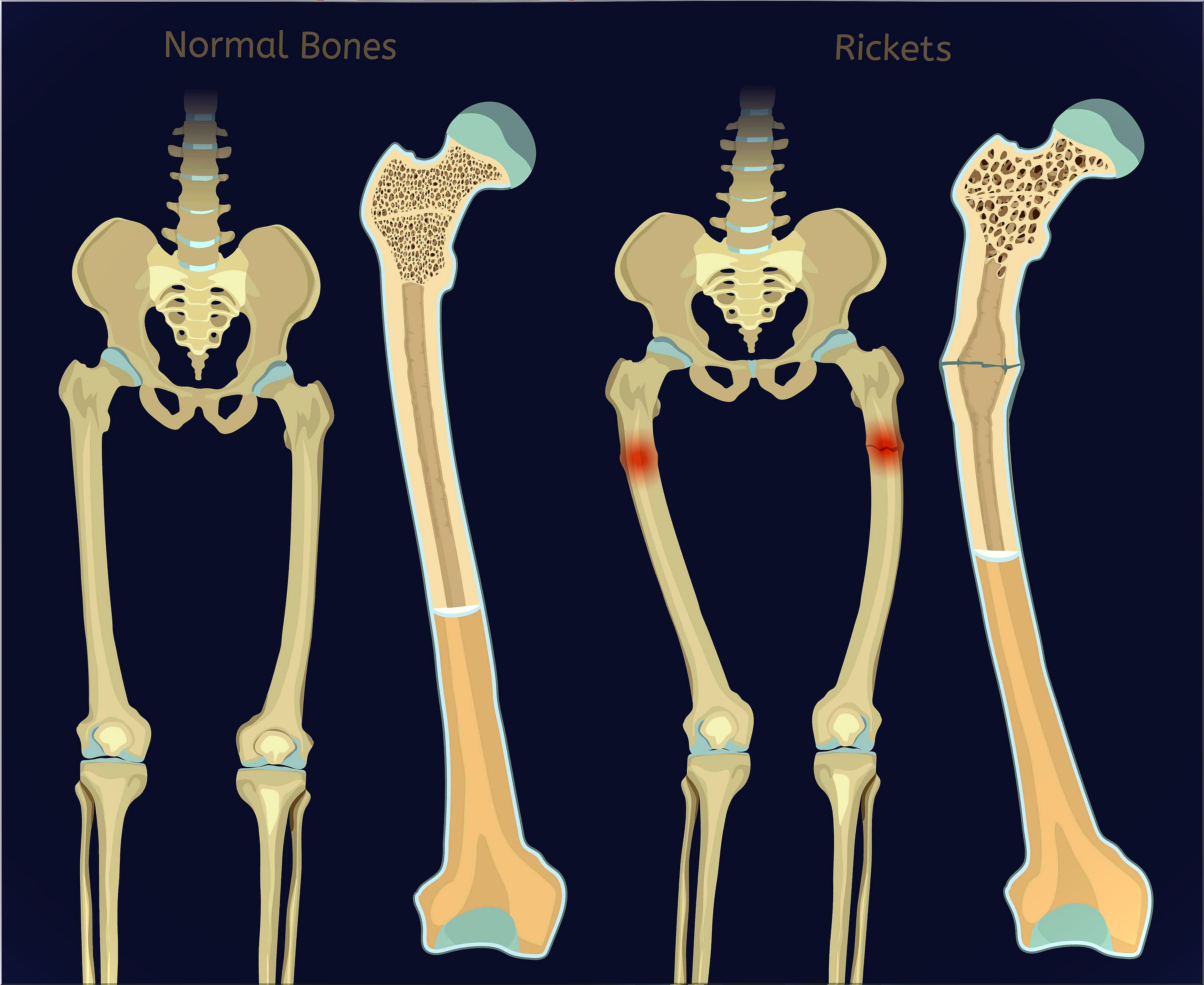 Rickets: vitamin D deficiency in children