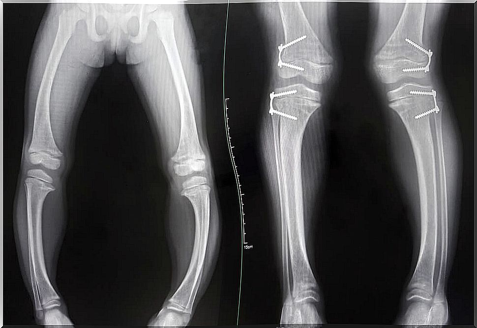 X-ray of bones with rickets.