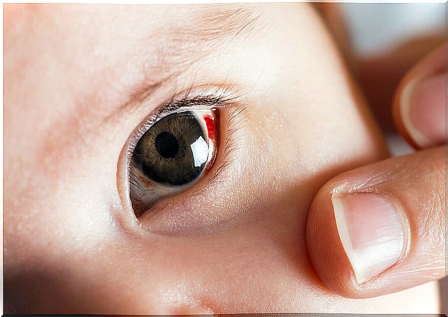 What are red spots on baby's eyes?