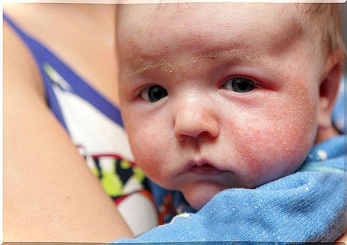 Eczema can be the cause of the scales on the baby's skin.