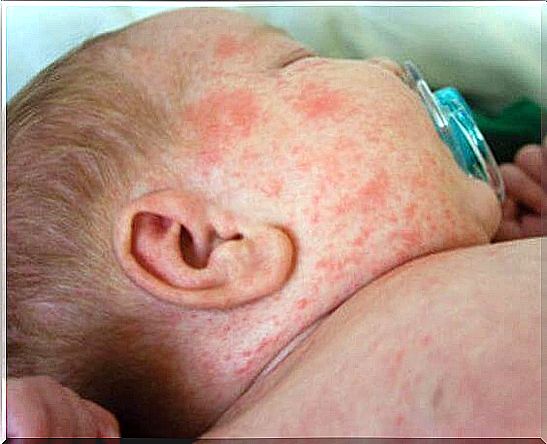 What are those little red spots on the baby's skin?